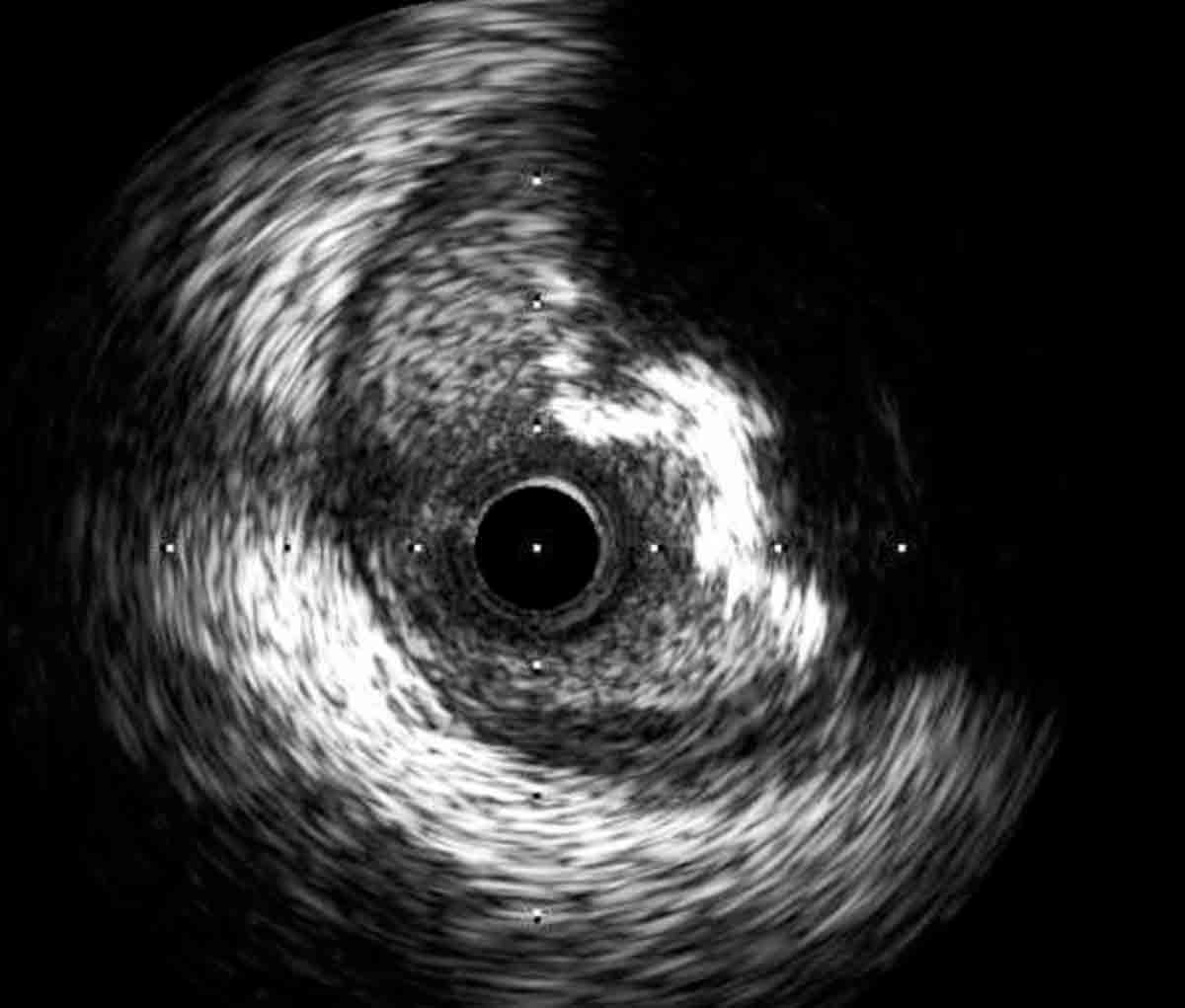 Cover Story | Intravascular Imaging: Understanding the Role of IVUS and