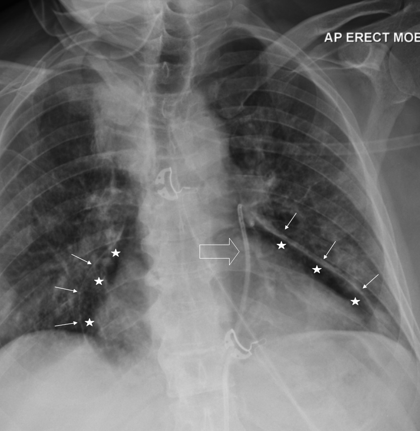pericardial effusion x ray
