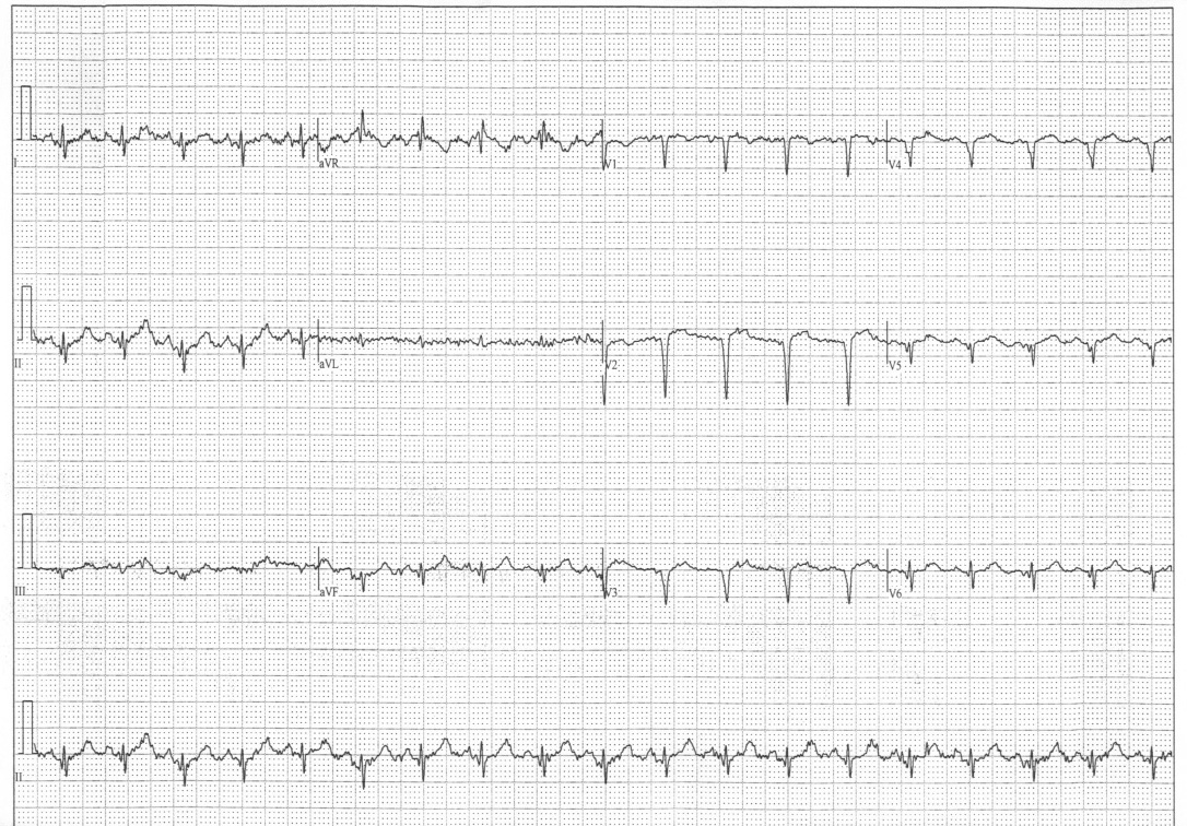 A 59-year-old Woman With Rectal Carcinoma: Cardiovascular 