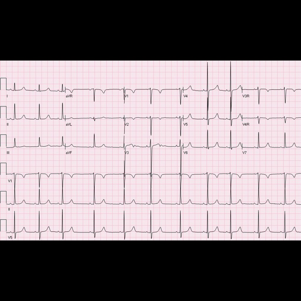 Figure 1: ECG