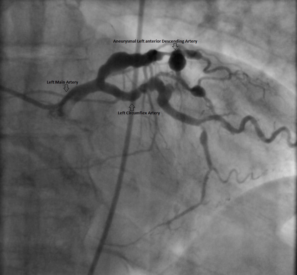 A Patient With A Giant Coronary Artery Aneurysm - American College Of ...