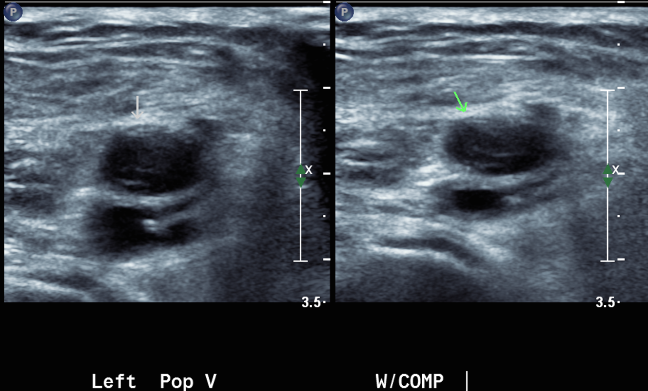 venous thrombosis ultrasound