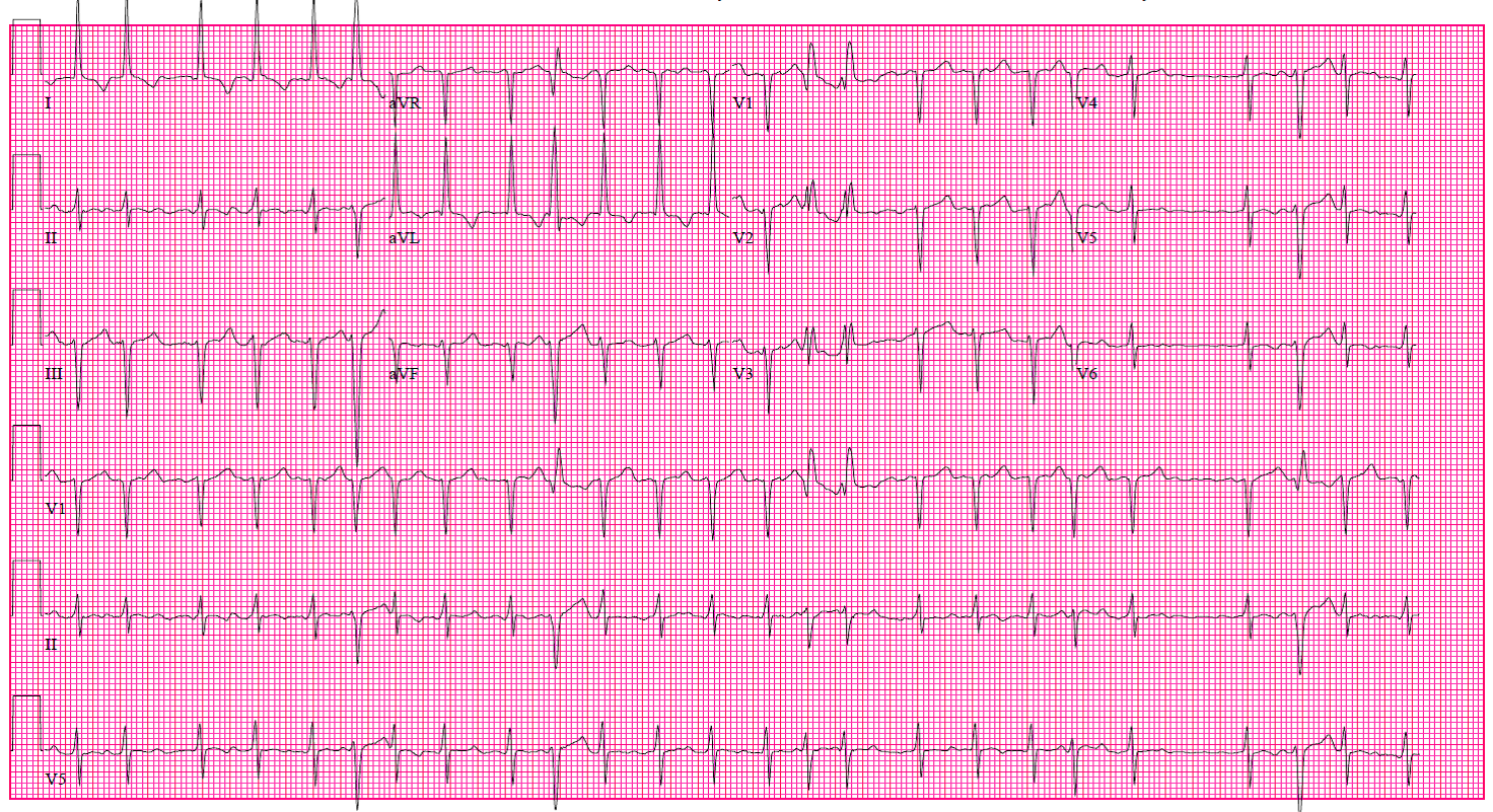A 63-Year-Old Man With Palpitations, Dizziness, and Severe LV Dysfunction -  American College of Cardiology
