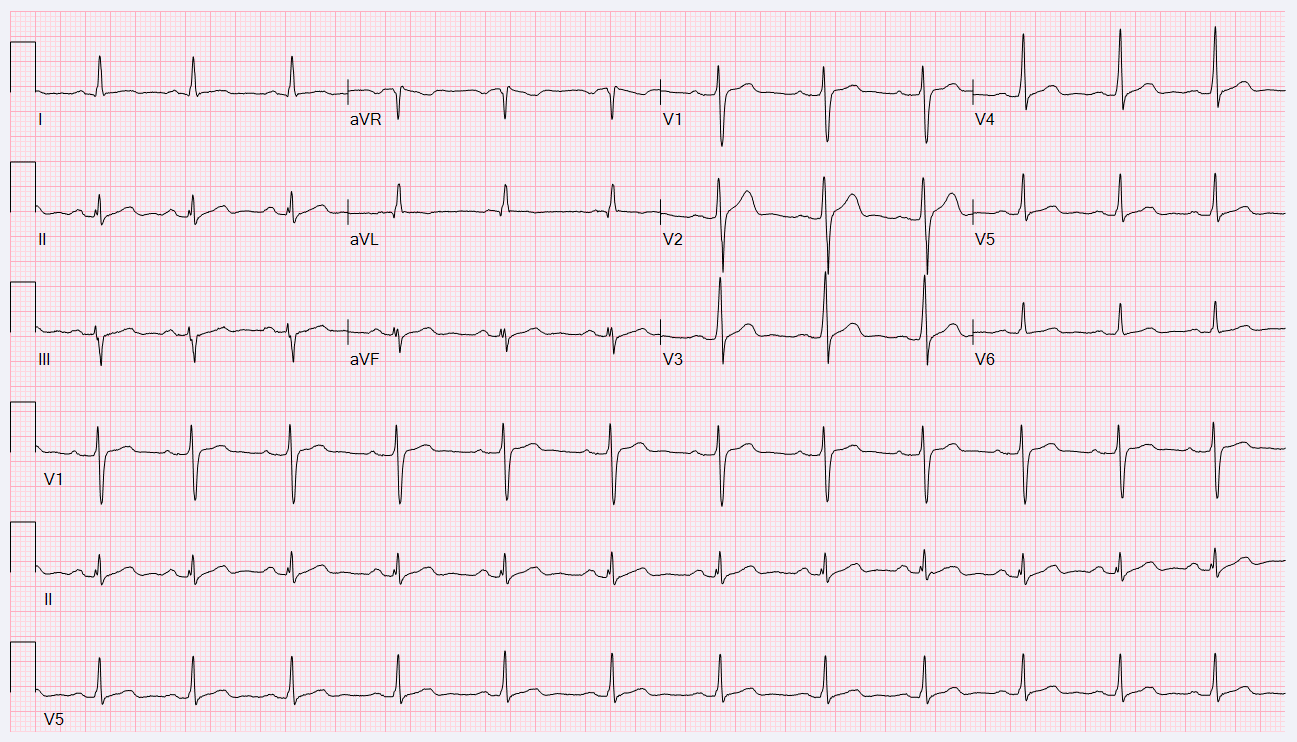 21-Year-Old Male With Transient Abnormal ECG - American College Of ...