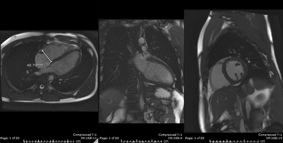 Multimodality Imaging In Athletes: Addressing The "Gray Zone ...