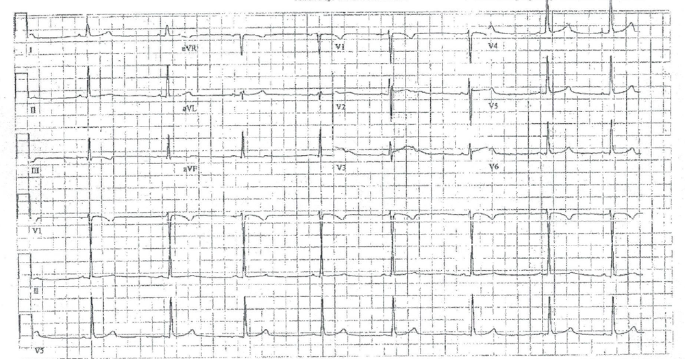 A 19-Year-Old Female Athlete With WPW Electrocardiogram - American ...
