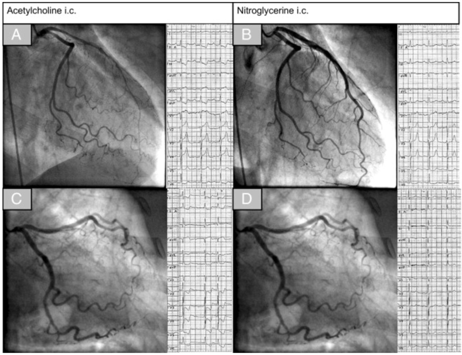 The Significance Of Vasospasm In Stable Coronary Artery Disease ...