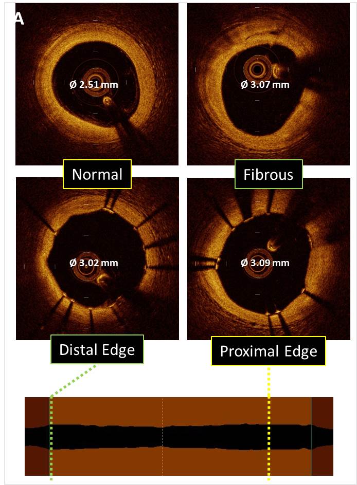 Intravascular OCT In PCI - American College Of Cardiology