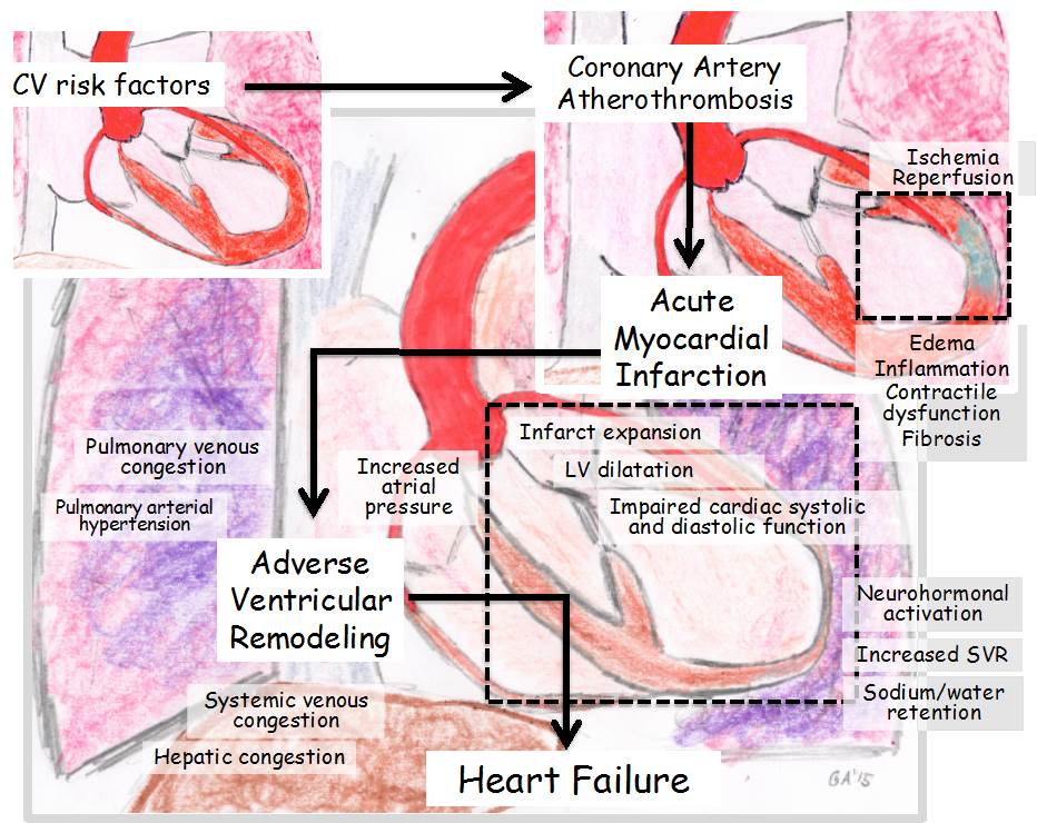Progression of Left Ventricular Myocardial Dysfunction in Systemic