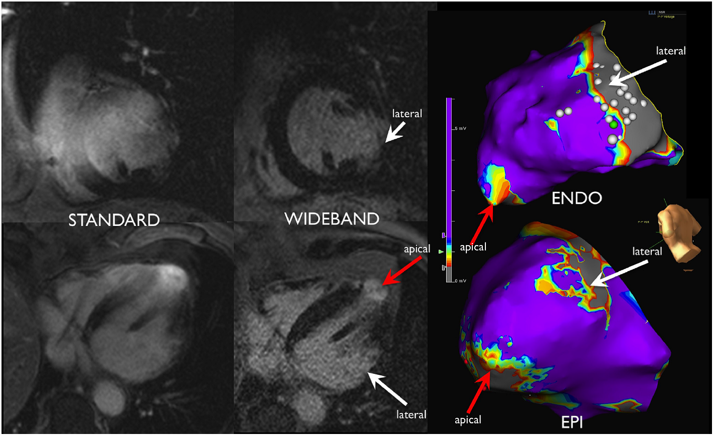 MRI In Patients With Implanted Devices: Current Controversies ...