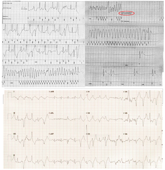 The Athlete With Catecholaminergic Polymorphic Ventricular Tachycardia American College Of Cardiology