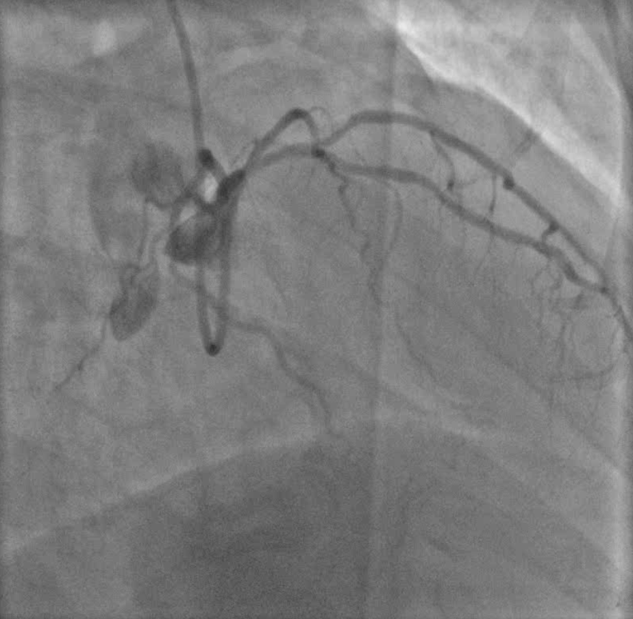 Use Of Fractional Flow Reserve In Acs American College Of Cardiology