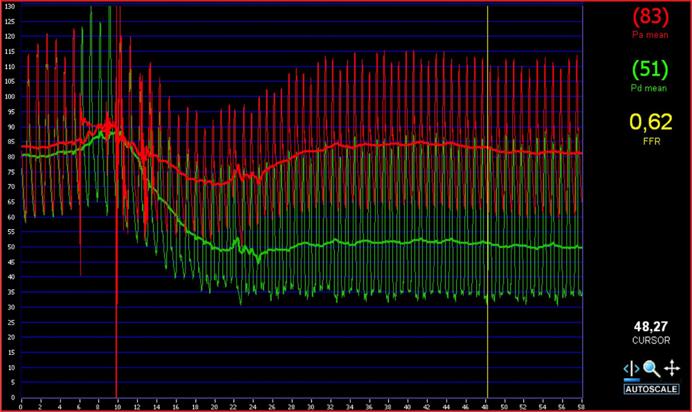 Hemodynamic Assessment of Stable, Intermediate Lesions in the