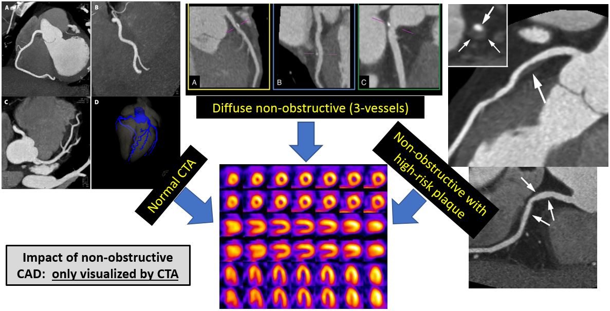 Coronary CTA Should Be the Initial Test in Most Patients With