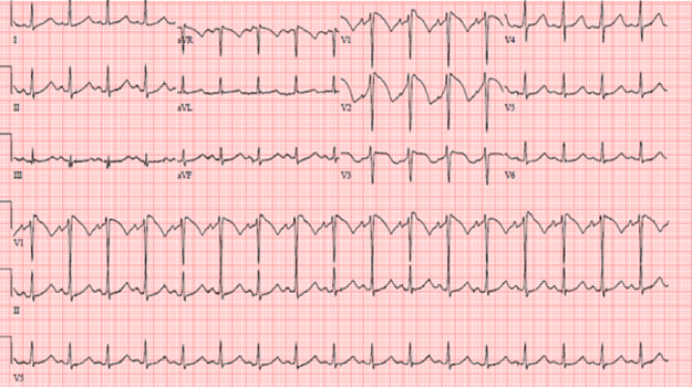 Arrhythmias and Clinical EP - American College of Cardiology