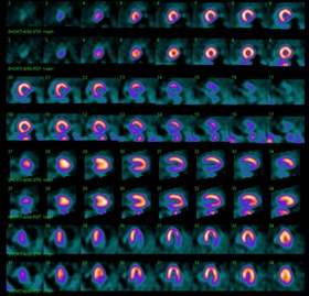 Figure 1: A Patient With a History of HTN and Hyperlipidemia Was Referred For a Dyspnea Evaluation