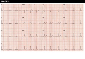 Figure 1: Angina Pectoris Despite Normal Coronary Angiography: Need for Specialist Care