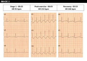 Figure 2: Angina Pectoris Despite Normal Coronary Angiography: Need for Specialist Care