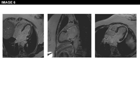Figure 6: Angina Pectoris Despite Normal Coronary Angiography: Need for Specialist Care