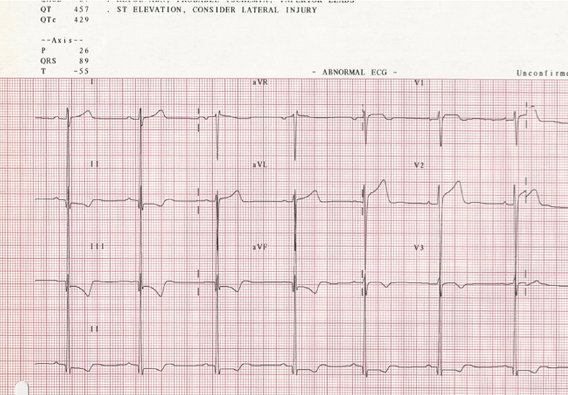 19-Year-Old Male Athlete With Bicuspid Aortic Valve and Athletic Heart Needing Clearance Prior to Professional Soccer Tryout