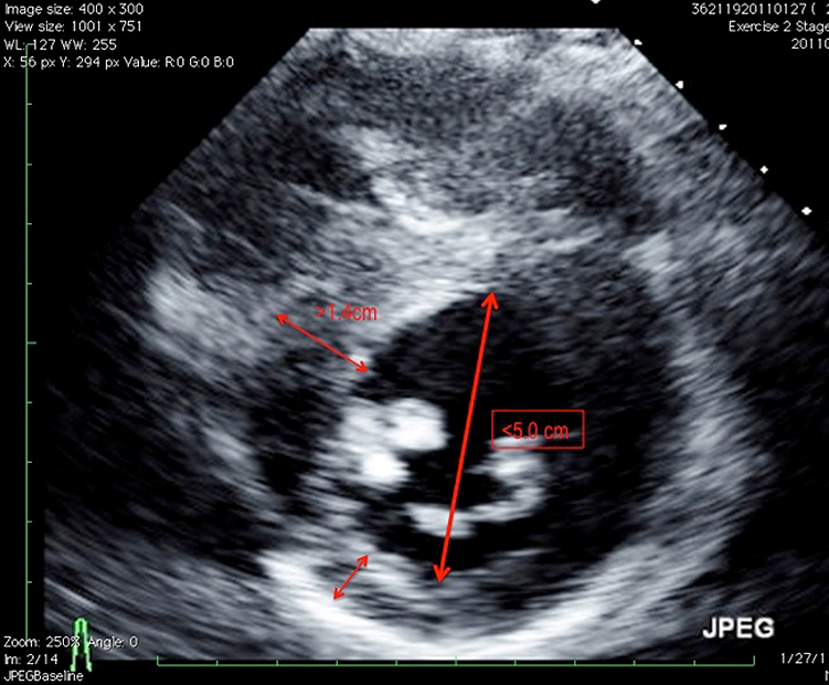 19-Year-Old Male Athlete With Bicuspid Aortic Valve and Athletic Heart Needing Clearance Prior to Professional Soccer Tryout