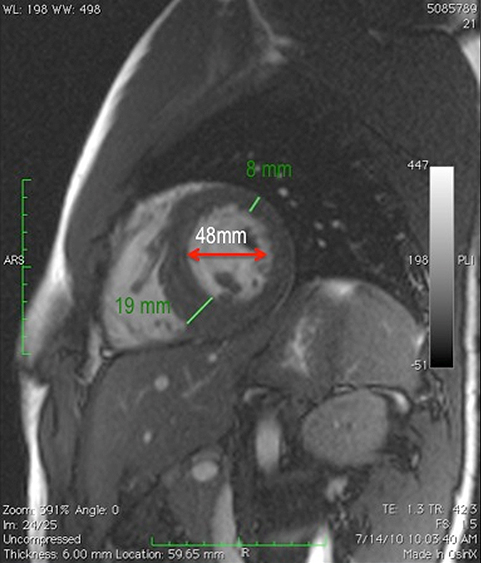 19-Year-Old Male Athlete With Bicuspid Aortic Valve and Athletic Heart Needing Clearance Prior to Professional Soccer Tryout