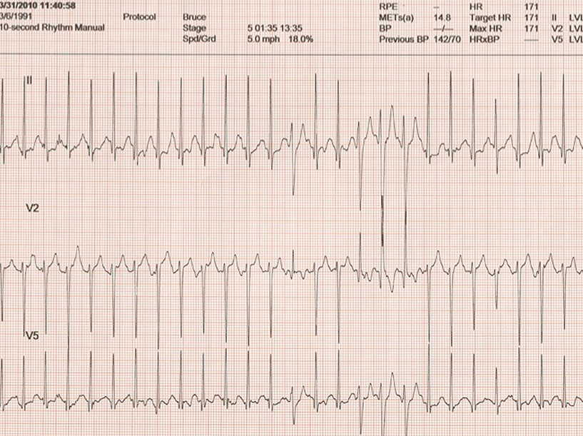 19-Year-Old Male Athlete With Bicuspid Aortic Valve and Athletic Heart Needing Clearance Prior to Professional Soccer Tryout