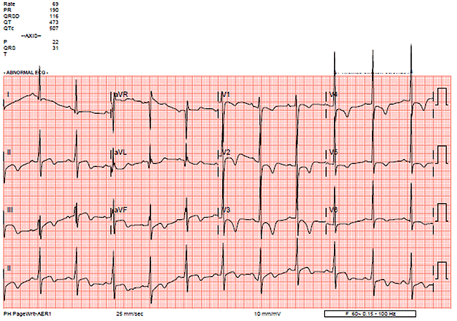 A 17-Year-Old Male Athlete Loses Consciousness and Becomes Apneic While Playing Basketball