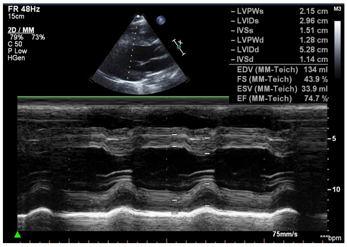 A 17-Year-Old Male Athlete Loses Consciousness and Becomes Apneic While Playing Basketball