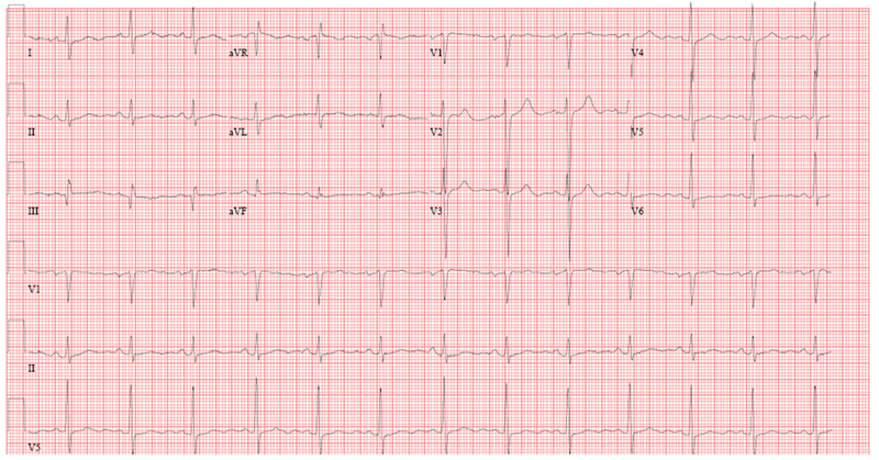 800px x 419px - A 60-Year-Old Male Presents With Shortness of Breath and Leg Swelling -  American College of Cardiology
