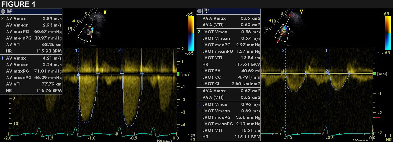 Figure 1: Valve-in-Valve TAVI With Postoperative High Gradient