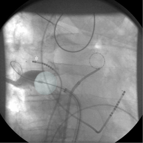 Cryoballoon Pullmonary Vein Isolation