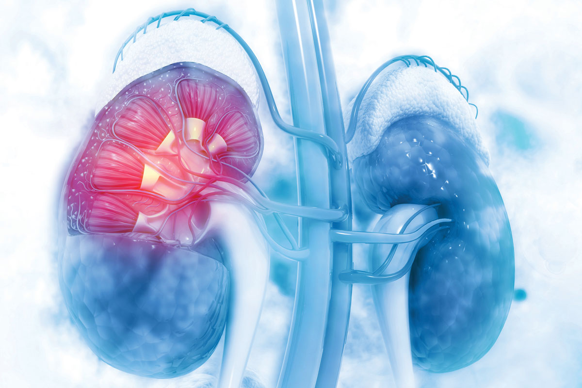 Cover Story Renal Denervation: Expanding Care For Treatment-Resistant Hypertension