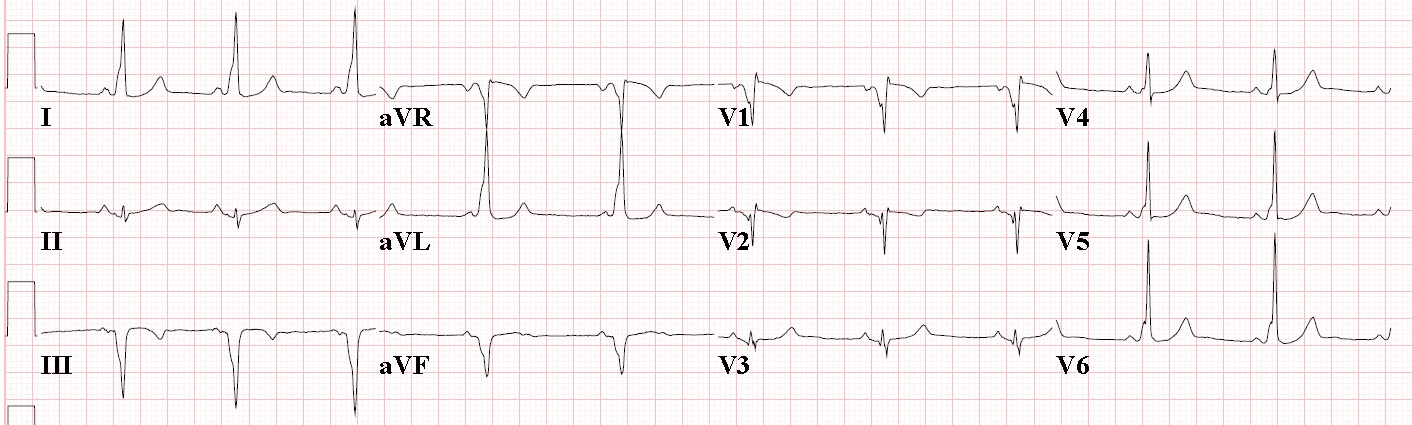 Old Inferior Wall Mi Ecg