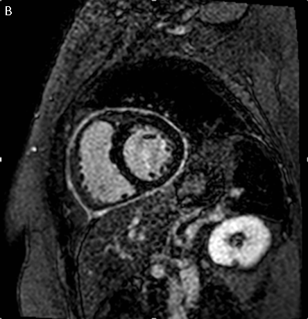 test heart inflammation Lupus for Pericarditis Recurrent Latest Treatment Approach