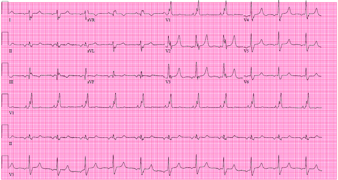 ECG of the Month: Right Bundle Branch Block and Myocardial 