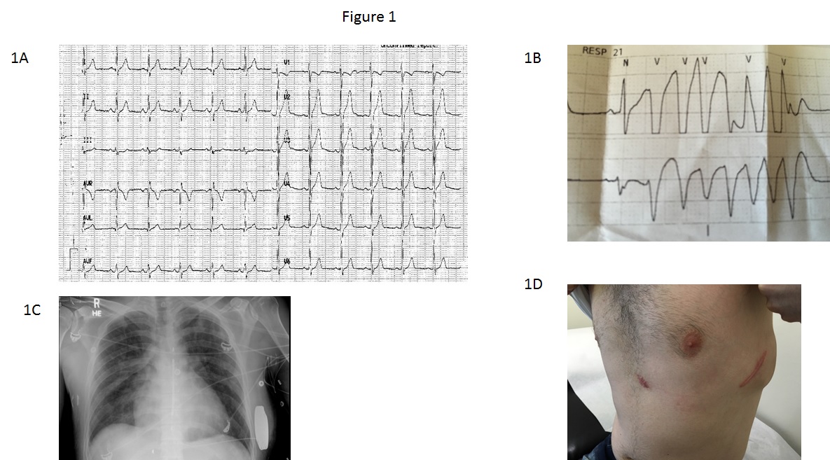 Short Qt Syndrome American College Of Cardiology